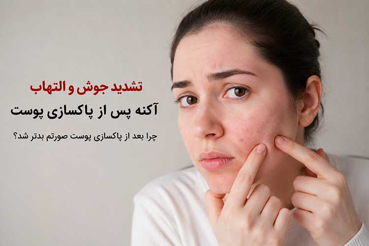 جوش بعد از پاکسازی پوست