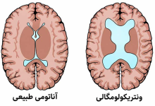 جدول اندازه نرمال بطن مغز جنین