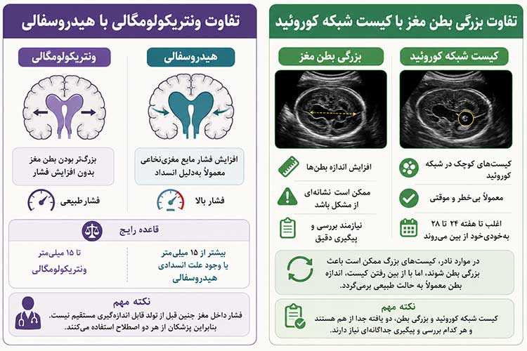 بطن مغز ونتریکولومگالی