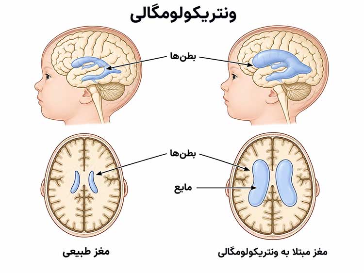 بطن مغز بزرگی بطن مغز جنین